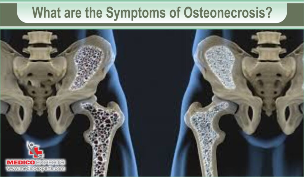 symptoms of Osteonecrosis 