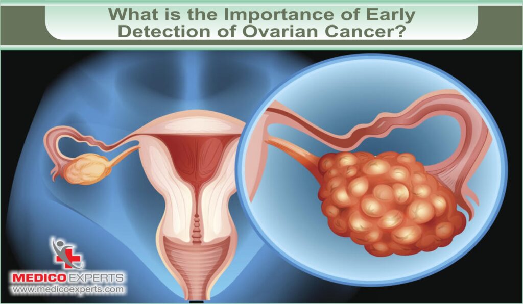 is ovarian cancer treatable | MedicoExperts