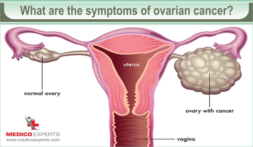 symptoms of ovarian cancer