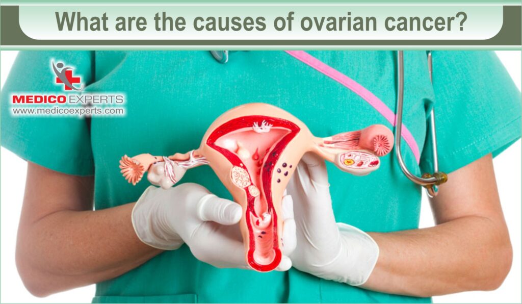 causes of ovarian cancer