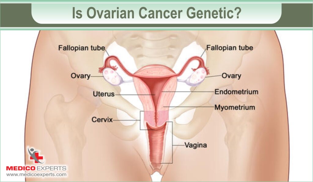 is ovarian cancer is genetic?