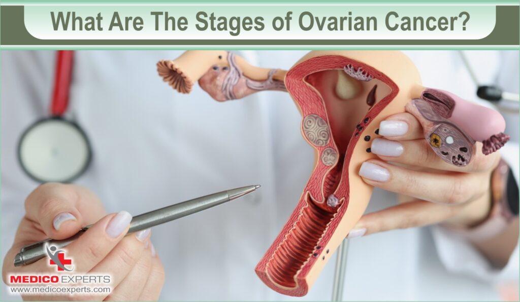 stages of ovarian cancer