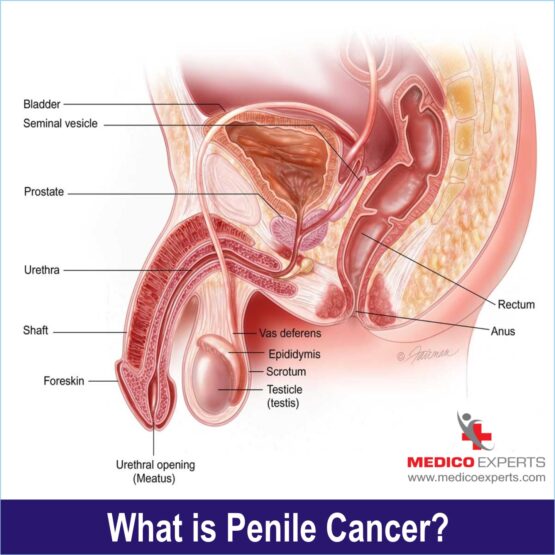 what is penile cancer