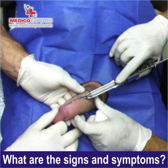 signs and symptoms of penile cancer