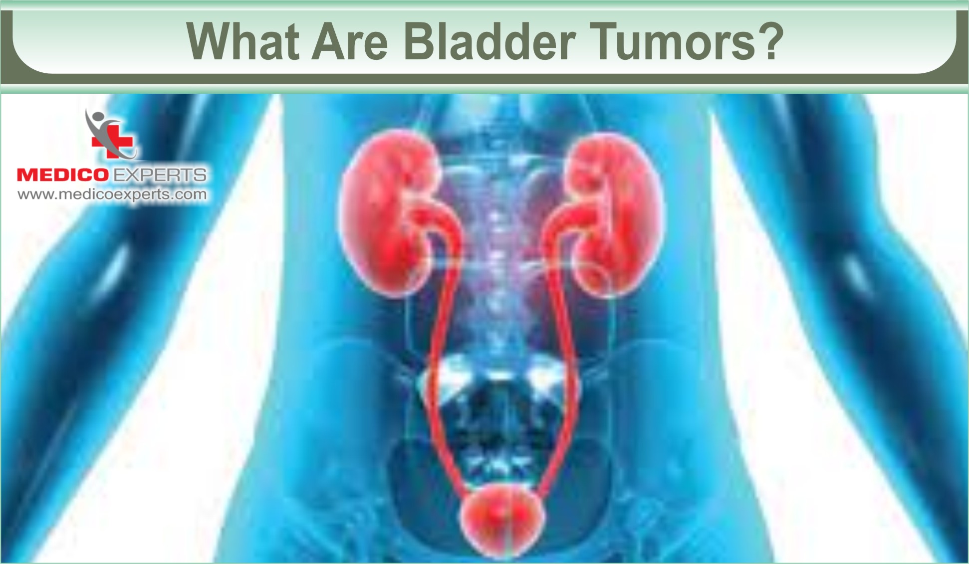 Bladder Tumor Removal: A Roadmap to Renewed Health