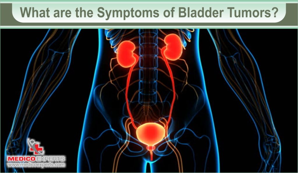 Bladder Tumor Removal: A Roadmap to Renewed Health