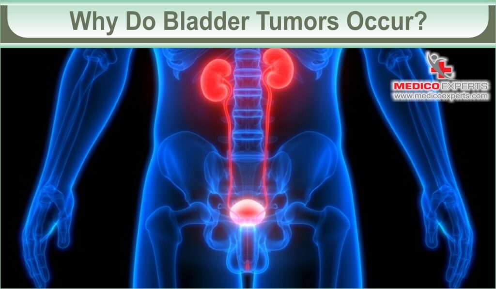 Bladder Tumor Removal: A Roadmap to Renewed Health