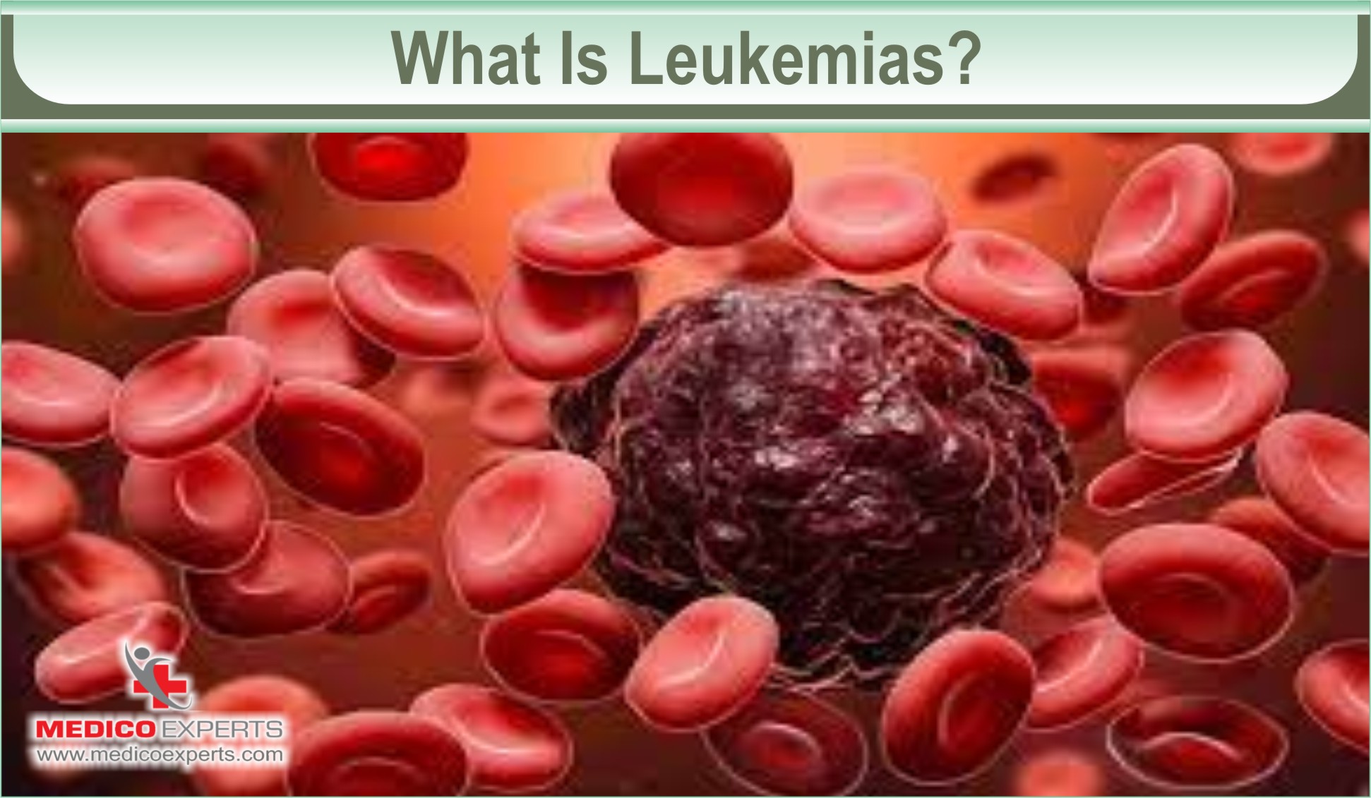 Acute Leukemia In Adults A Closer Look