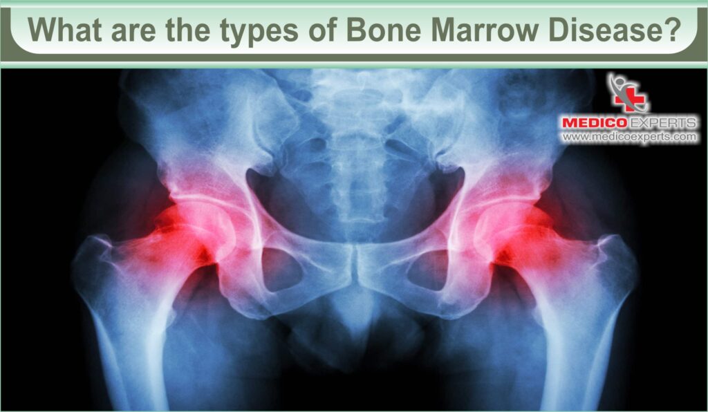 bone marrow disease | MedicoExperts