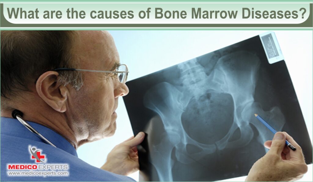 bone marrow disease | MedicoExperts