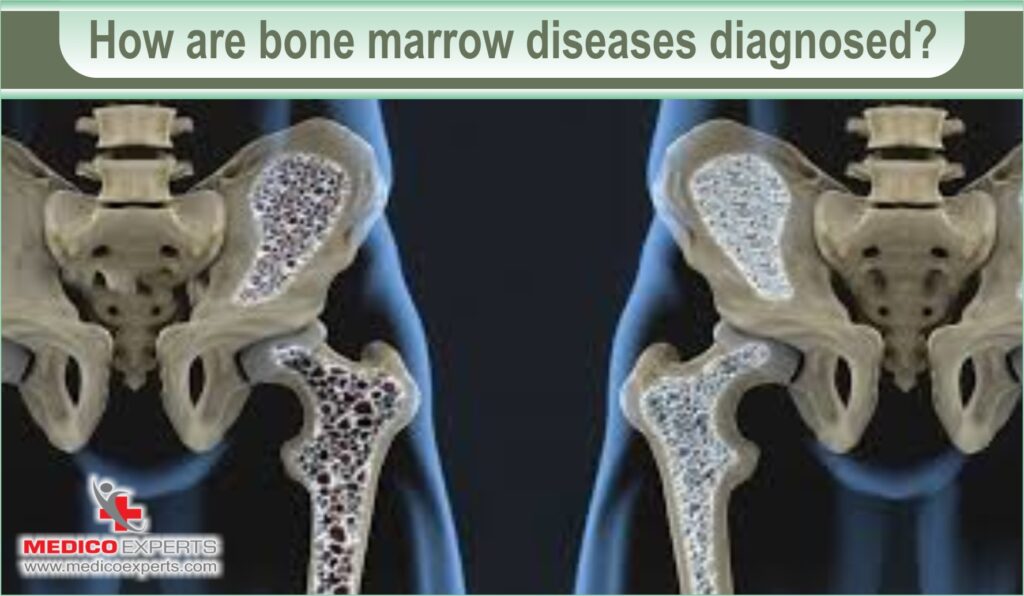 bone marrow disease | MedicoExperts