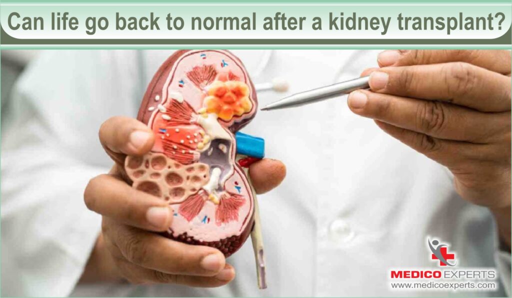 maximum life after kidney transplant | MedicoExperts