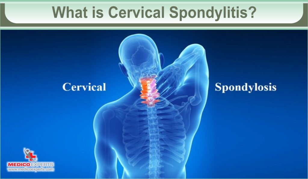 Answered Can Cervical Spondylosis be Cured