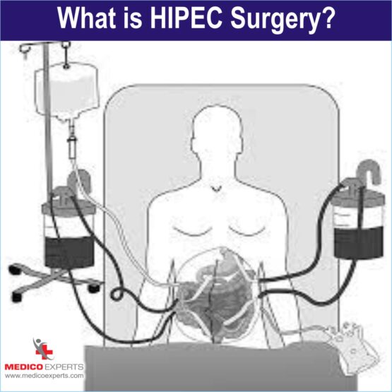 What is HIPEC Surgery?