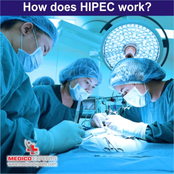 How does HIPEC work?