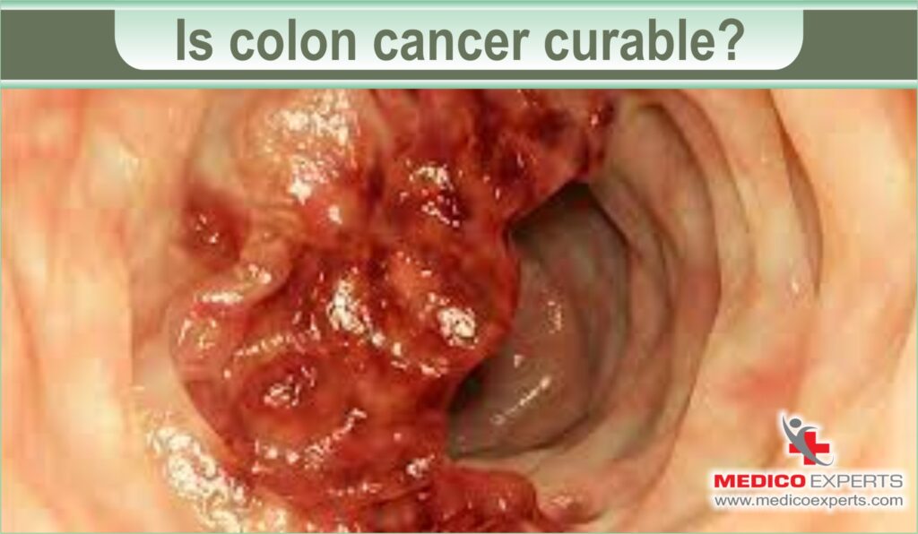 Is colon cancer curable?