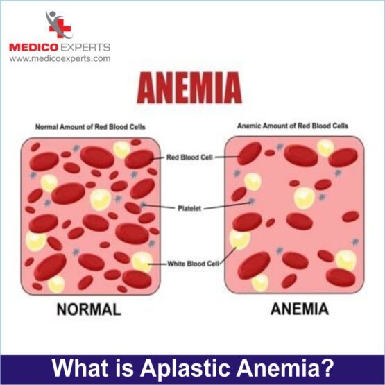 What is Aplastic Anemia?