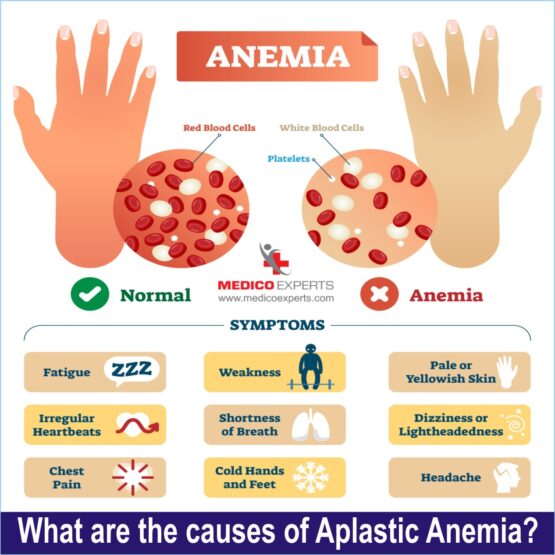 What are the causes of Aplastic Anemia?