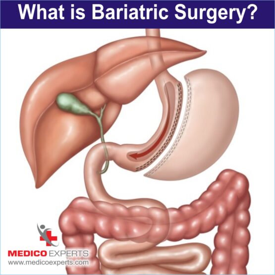 What is bariatric surgery