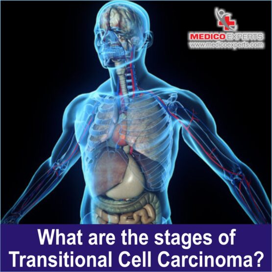 What are the stages of Transitional Cell Carcinoma?