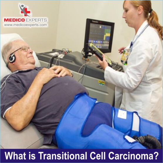 What is Transitional Cell Carcinoma?