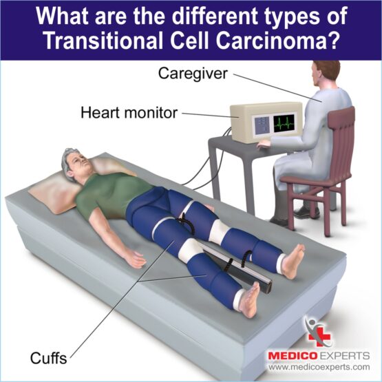 What are the different types of Transitional Cell Carcinoma?
