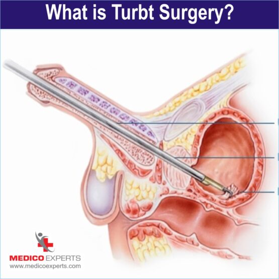 What is Turbt Surgery?