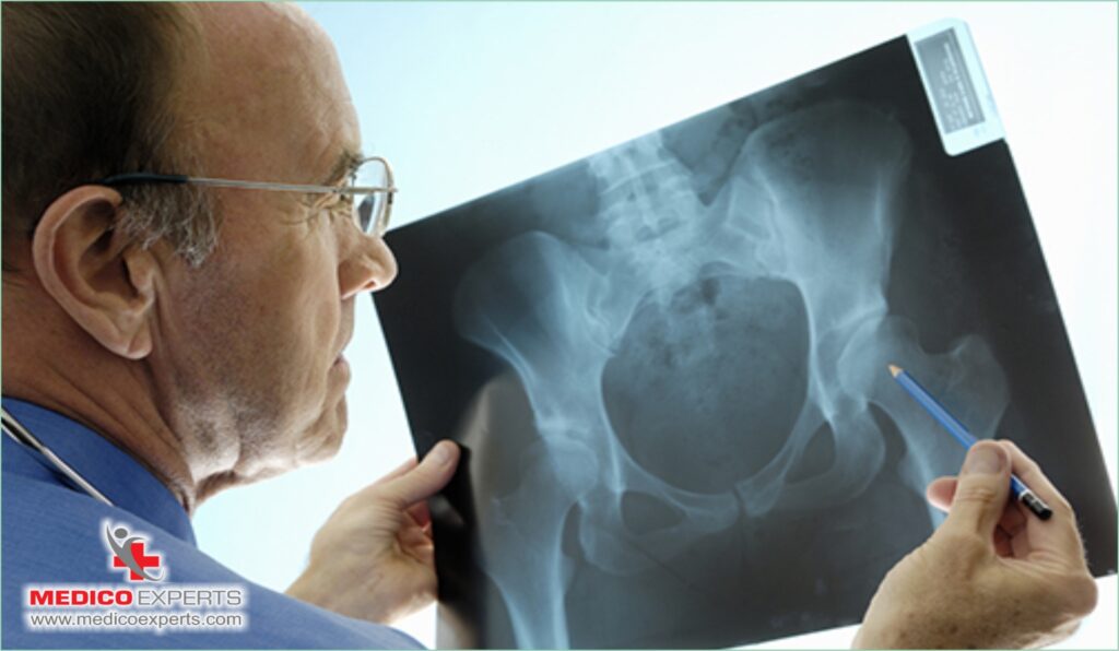 does hip replacement cure avascular necrosis, How can Avascular Necrosis be reversed?