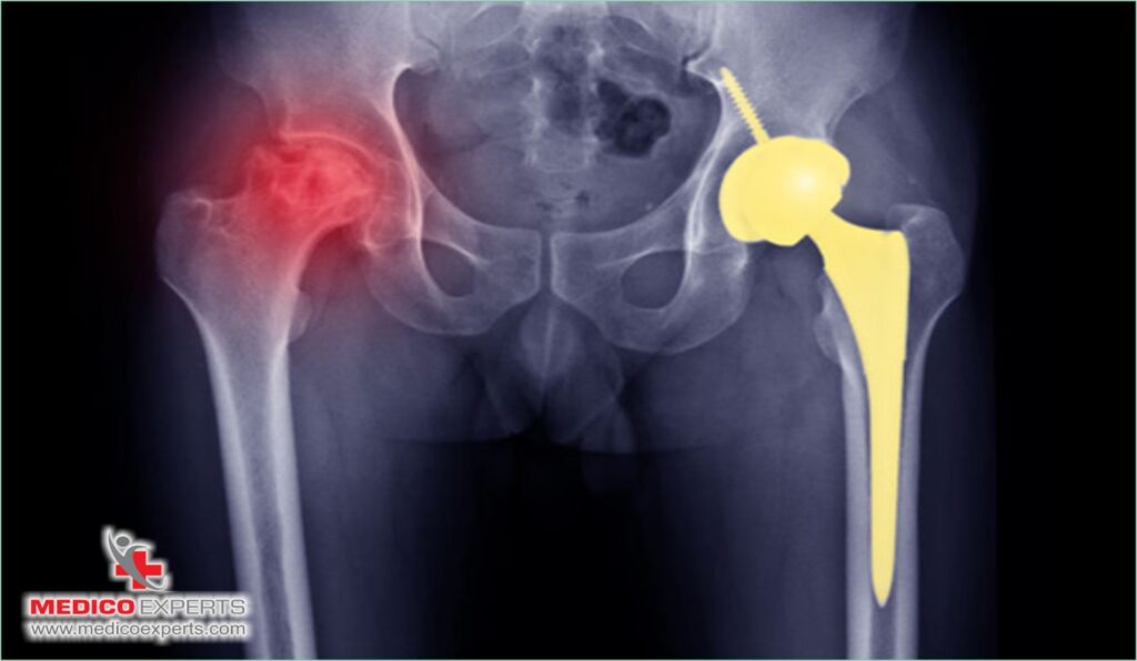 What conventional treatment options are available for Avascular Necrosis?, does hip replacement cure avascular necrosis