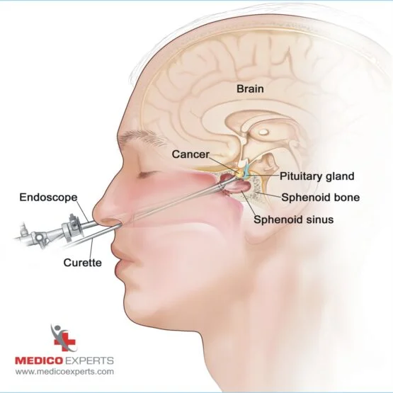 How to choose the best Neurosurgeon for Pituitary Tumor Treatment, how long is pituitary tumor surgery, how long does it take to recover from pituitary tumor surgery?