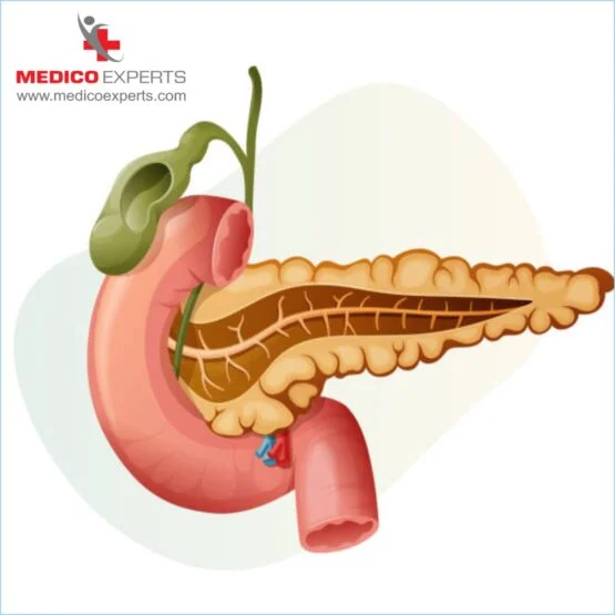 What are the causes and risk factors in pancreatic cancer cases, Can pancreatic cancer be cured, best hospital for pancreatic cancer treatment in india