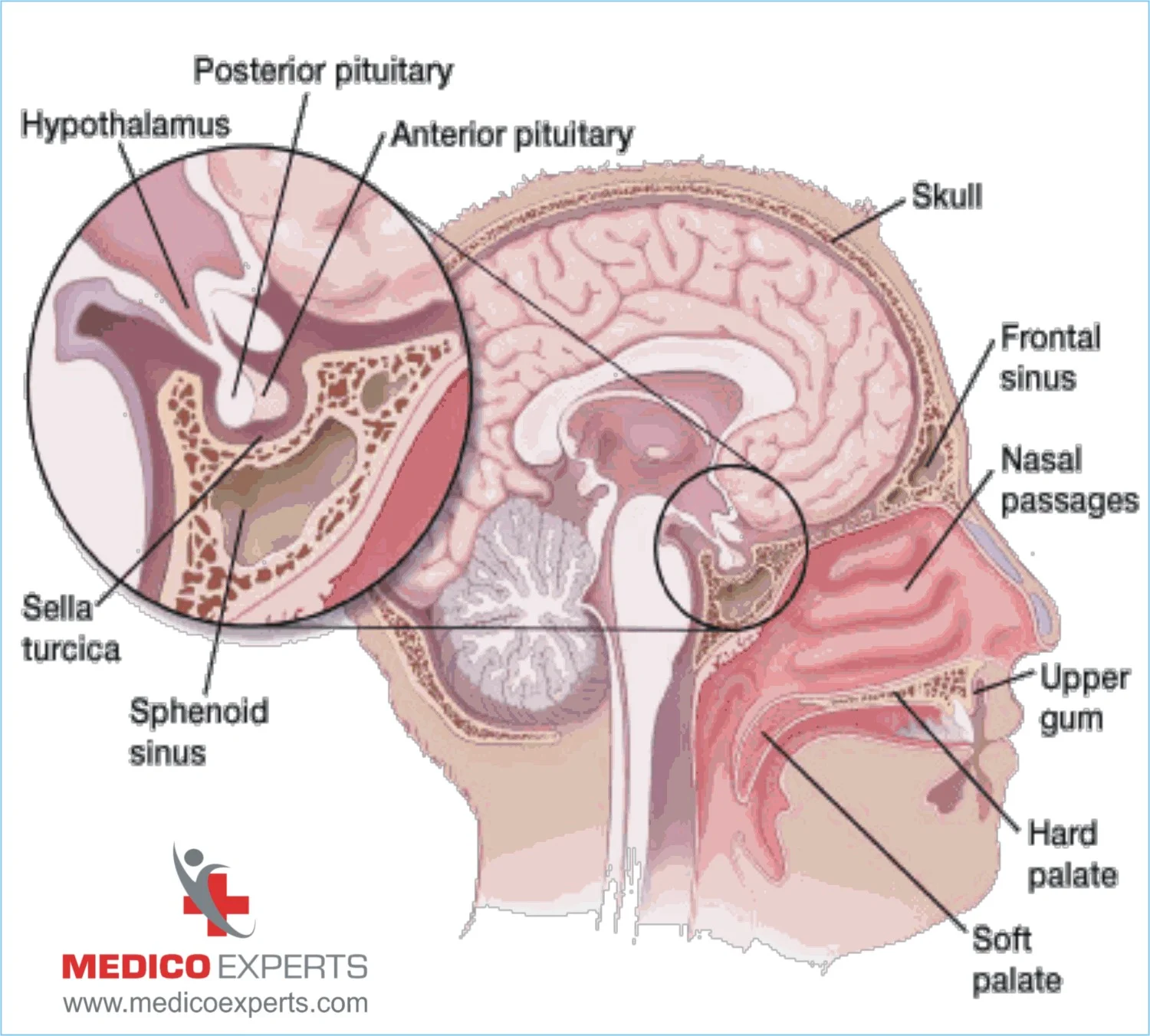 What are the different types of Pituitary Adenomas?, pituitary adenoma surgery success rate