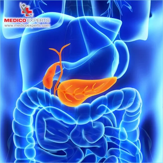 What are the different types of pancreatic cancer, Adenocarcinoma, Squamous Cell Carcinoma, Adenosquamous Carcinoma