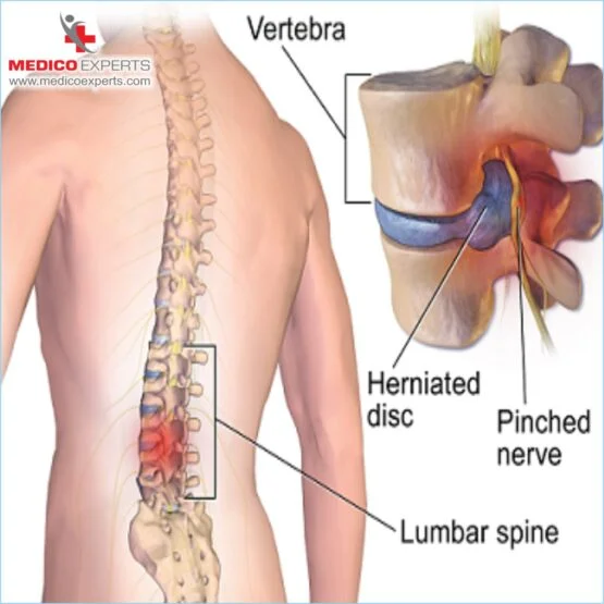 What are the risk factors for spinal cord injury? Stem Cell Therapy for Spinal Cord Injury in India