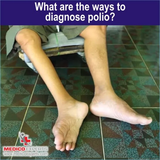 What are the ways to diagnose polio, polio treatment options