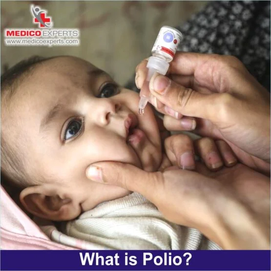 What is Polio, stem cell therapy for polio, treatment for polio affected leg