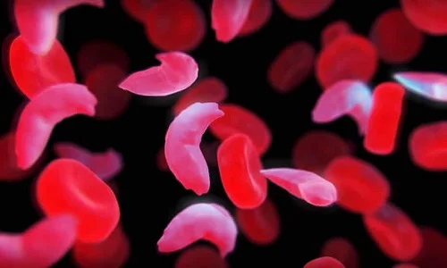 What is Sickle Cell Trait (SCT)? sickle cell treatment in india Is sickle cell painfull? Does sickle cell gets better with the age?