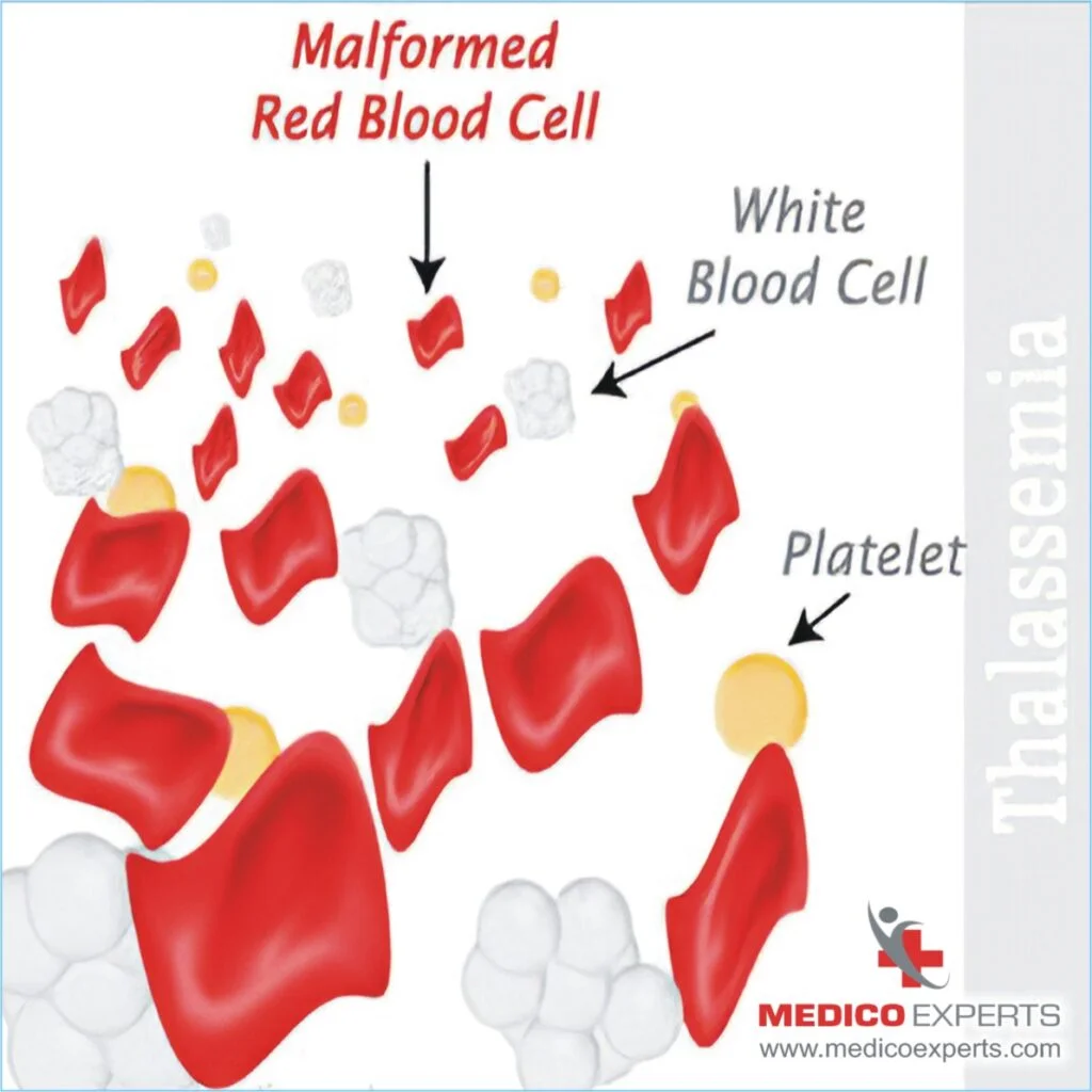 What is Thalassemia? beta thalassemia treatment in india alpha thalassemia treatment