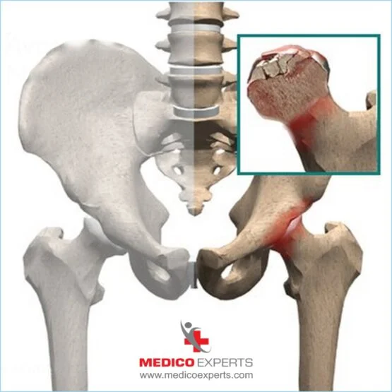 avn treatment without surgery, In simple terms, avascular necrosis (AVN) is a disease in which your bone tissues die due to a lack of blood supply.