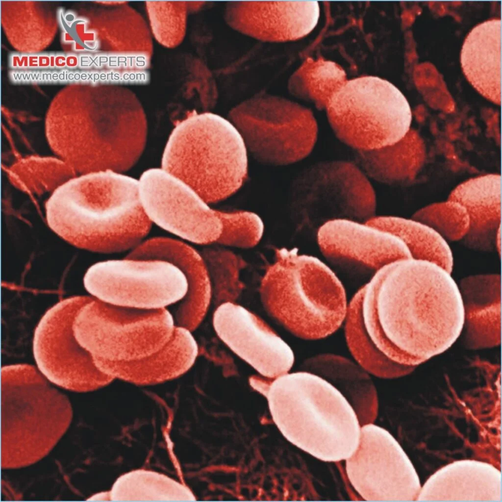 what are the causes of thalassemia thalassemia diagnosis test