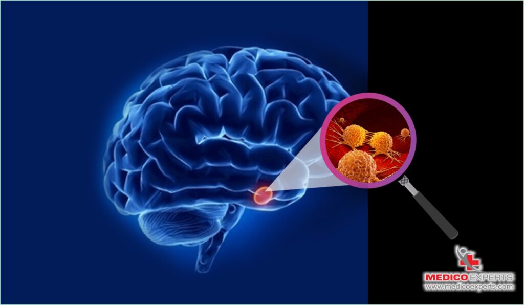 who is most likely to get motor neuron disease?, How does MND Starts