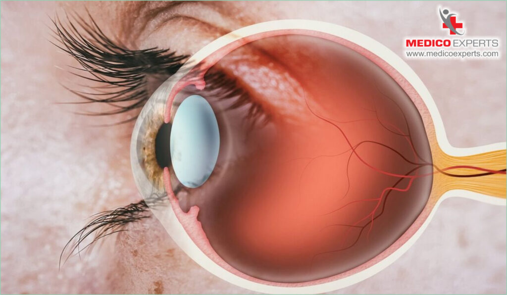 Expected Timeline for Vision Recovery, vision recovery timeline, visual improvement statistics